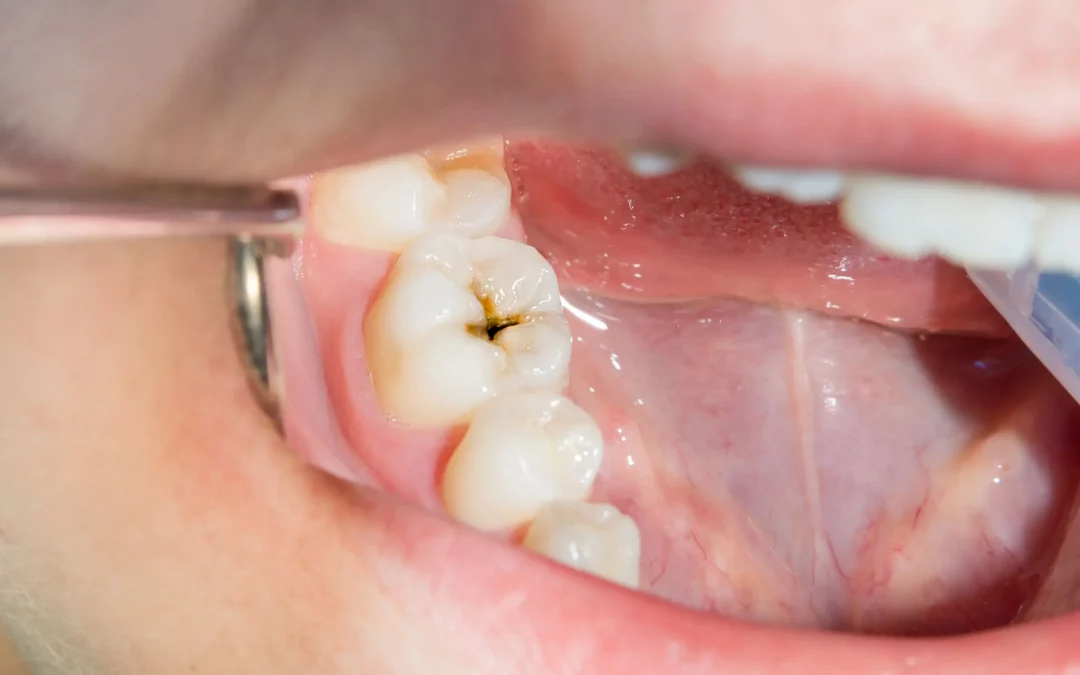 A Patient’s Guide to Tooth Wear